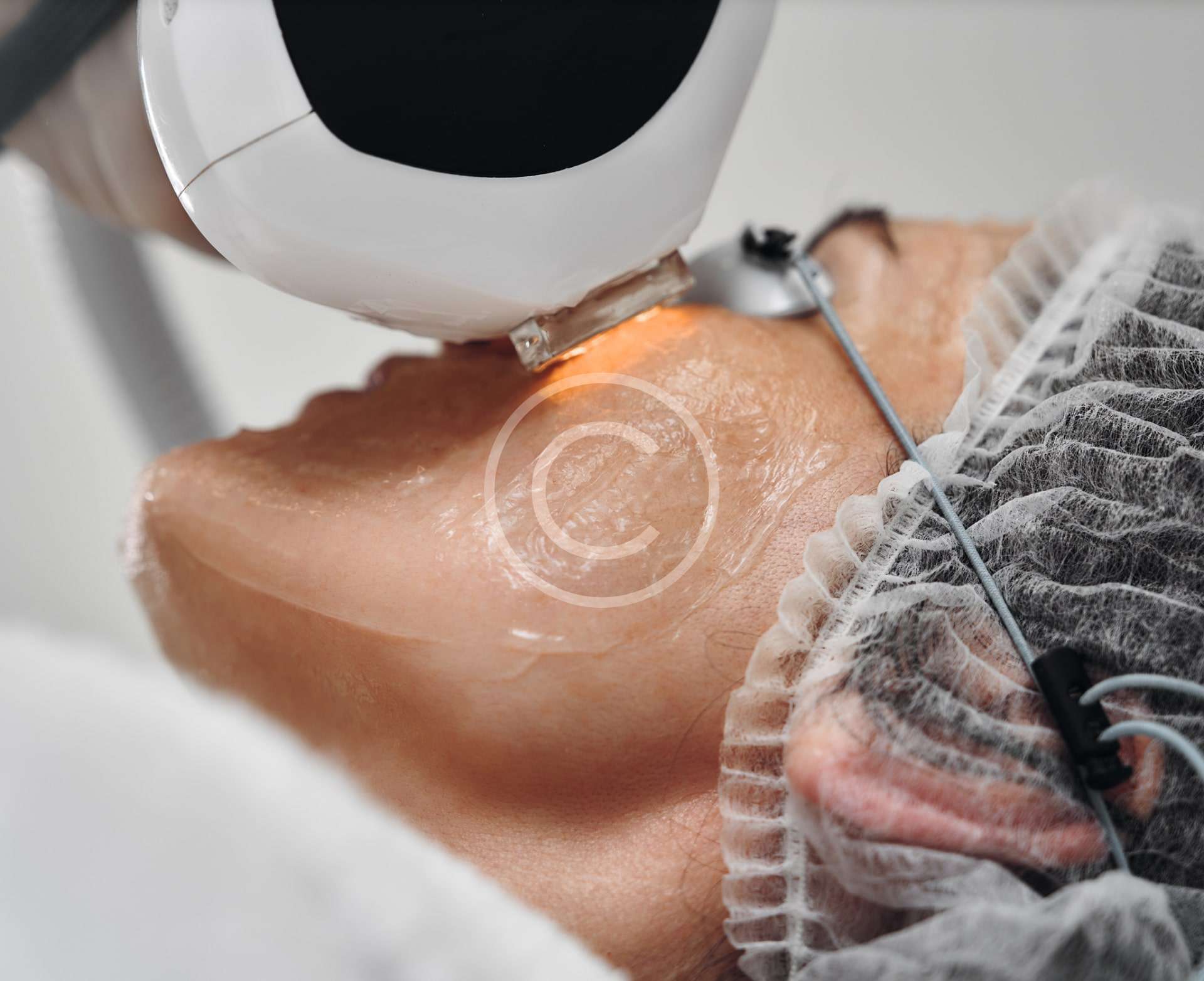 Laser resurfacing